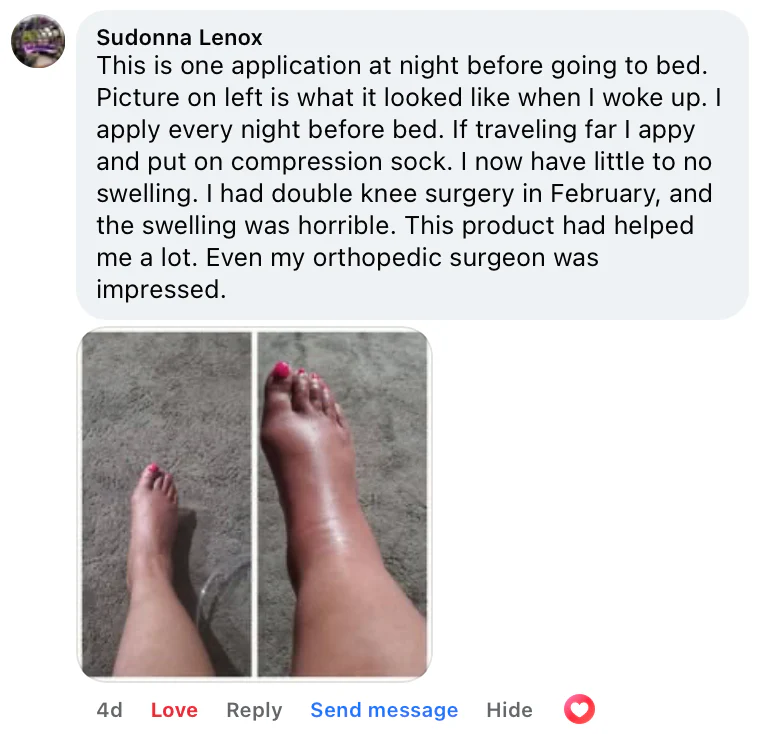 Before and after using Mirundo Miracle Leg Balm
